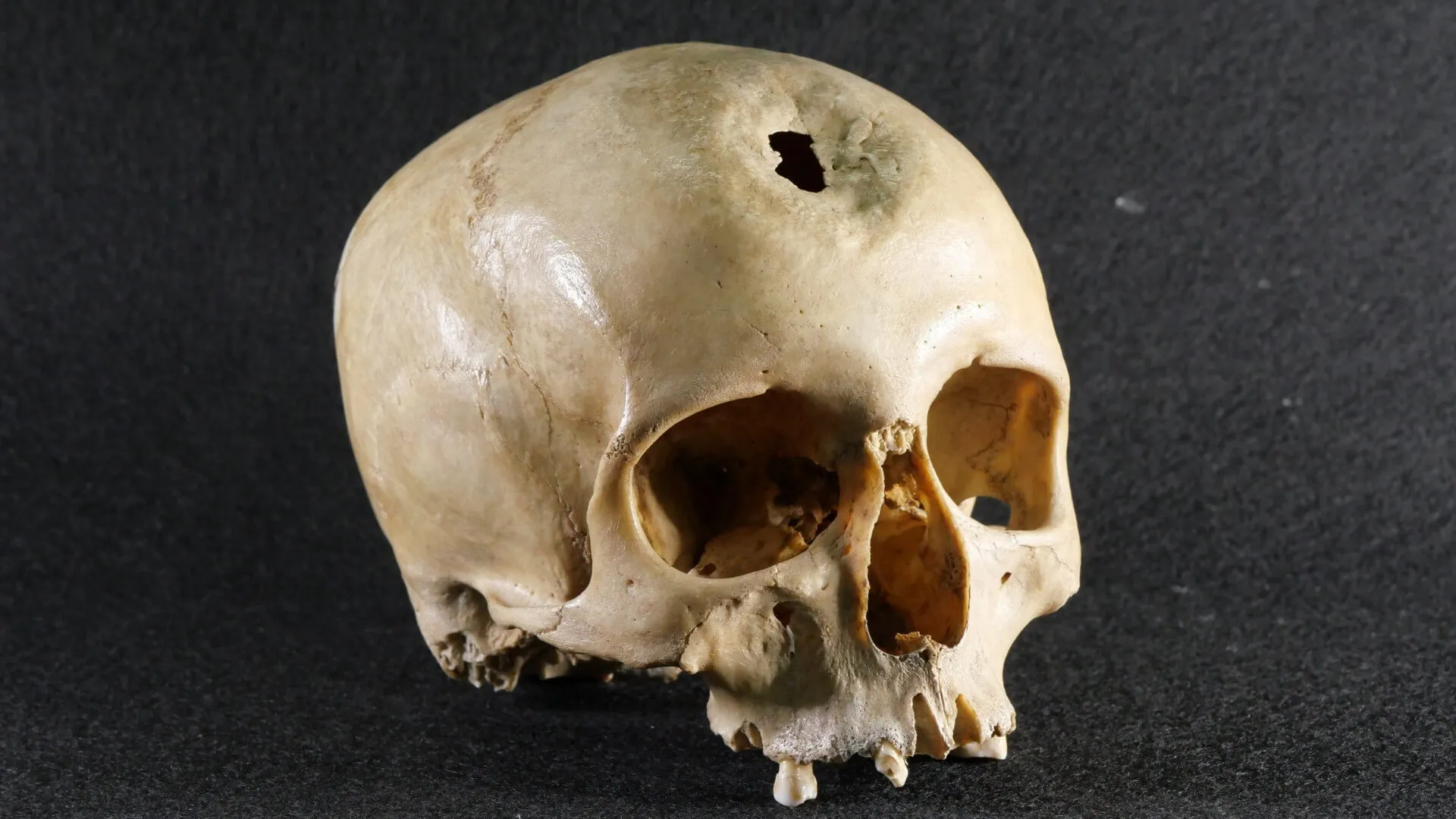 Trepanación Prehistórica: Historia de las Cirugías